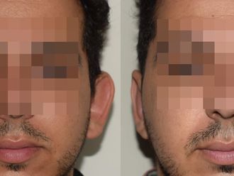 Otoplastia antes y después - 875770