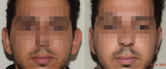 Dr. Carlos Cuesta Romero - Otoplastia