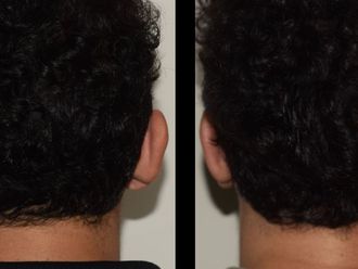 Otoplastia antes y después - 875771