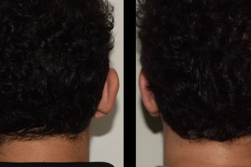 Otoplastia antes y después - 875771
