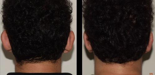 Dr. Carlos Cuesta Romero - Otoplastia