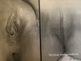 Labioplastia antes y después - 879673