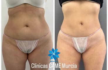 Clínicas CAME Murcia - coolsculpting