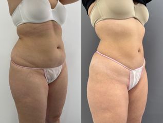 Coolsculpting ( criolipolisis médica )