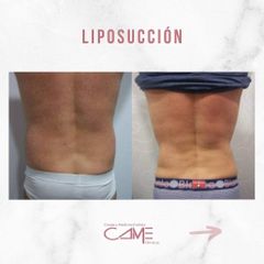 Liposucción - Clínicas CAME Murcia