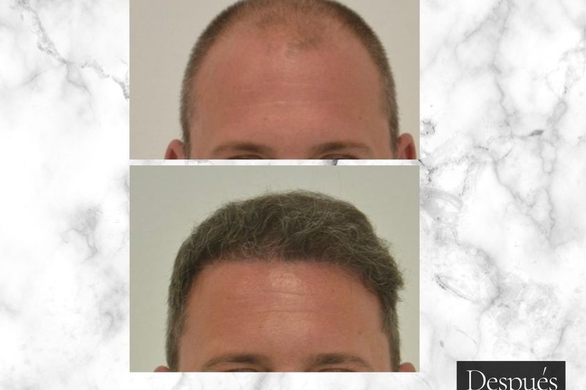 Microinjertos antes y después - 855577