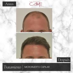 Microinjerto capilar - Clínicas CAME Murcia