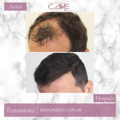 Microinjerto capilar - Clínicas CAME Murcia