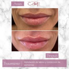 Aumento de labios - Clínicas CAME Murcia