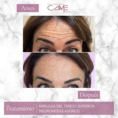 Rellenos faciales - Clínicas CAME Murcia