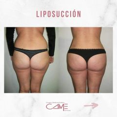 Liposucción - Clínicas CAME Murcia