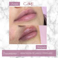 Aumento de labios - Clínicas CAME Murcia