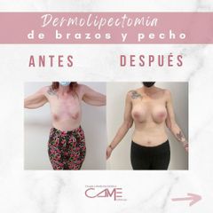 Dermolipectomía - Clínicas CAME Murcia