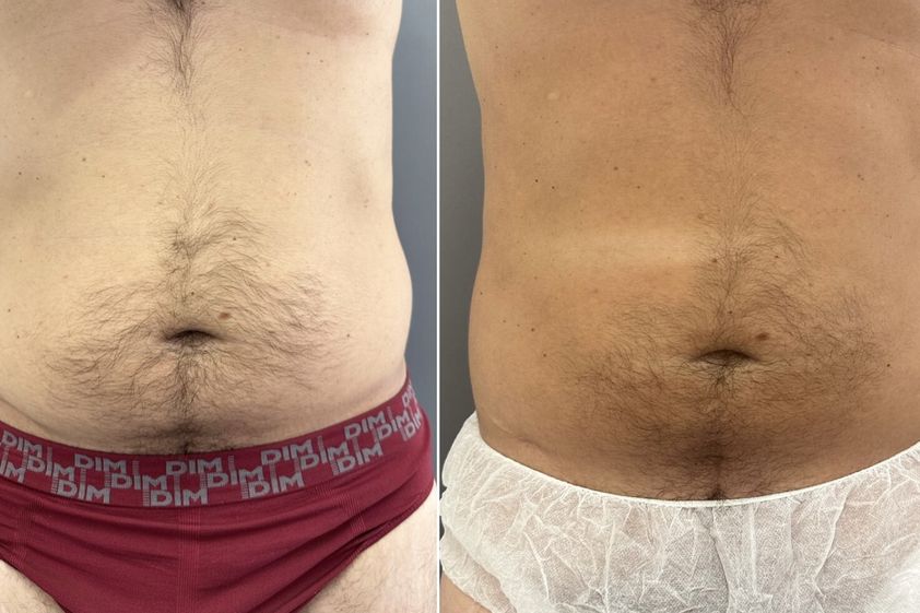 Criolipólisis antes y después - 863324