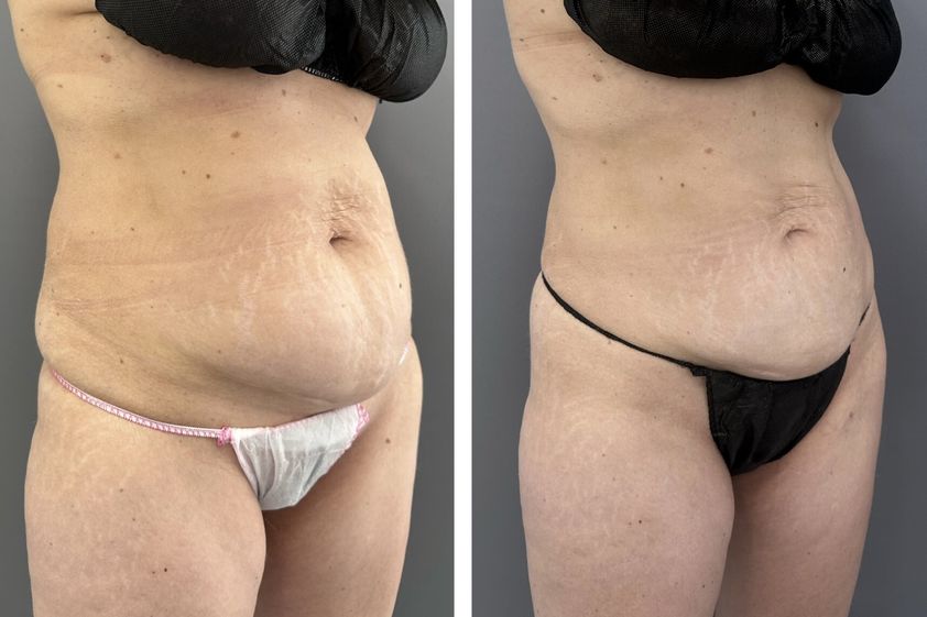 Criolipólisis antes y después - 863326
