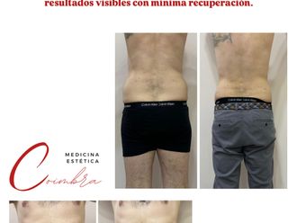 Lipoláser antes y después - 876776