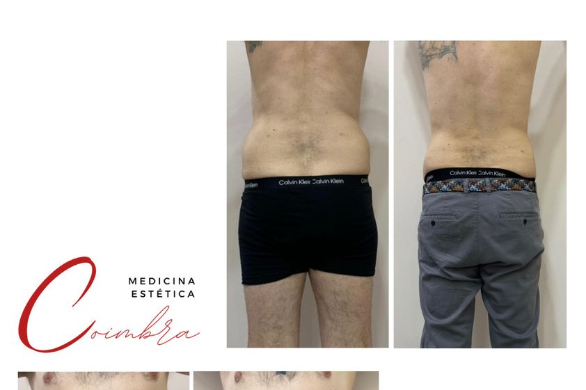 Lipoláser antes y después - 876776