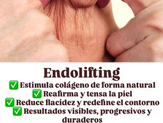 Lifting sin cirugía antes y después - 876778