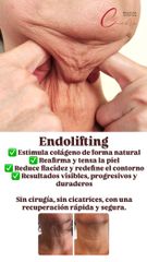 Endolifting - Medicina Estética Coimbra