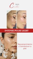 IPL- Tratamiento anti manchas - Medicina Estética Coimbra