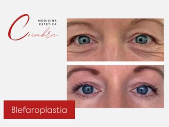 Blefaroplastia antes y después - 876780