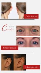 Blefaroplastia - Medicina Estética Coimbra