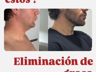 Liposucción de papada antes y después - 876781