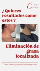 Smartlipo en papada - Medicina Estética Coimbra