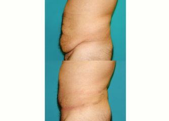 Antes y después Abdominoplastia
