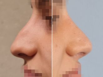 Rinoplastia antes y después - 878815