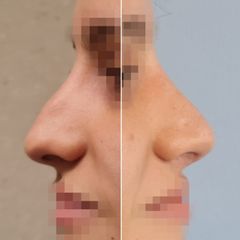 Dra. Souha Marouan Ababou - Rinoplastia