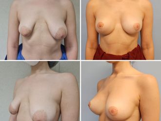 Mastopexia antes y después - 878818