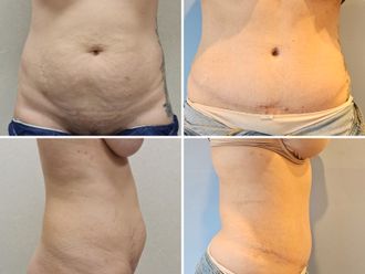 Lipoescultura antes y después - 878819