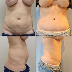 Dra. Souha Marouan Ababou - Lipoescultura