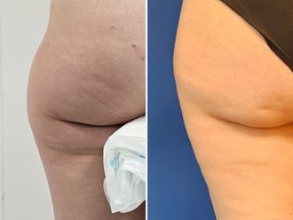 Lipoescultura antes y después - 878820