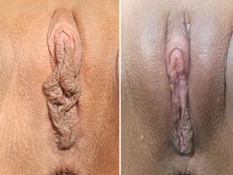 Labioplastia antes y después - 878821