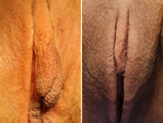 Labioplastia antes y después - 878823