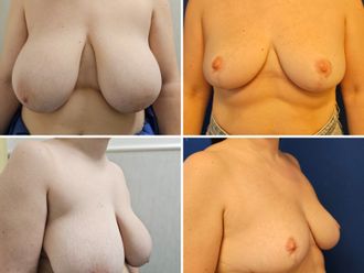 Mastopexia antes y después - 878829