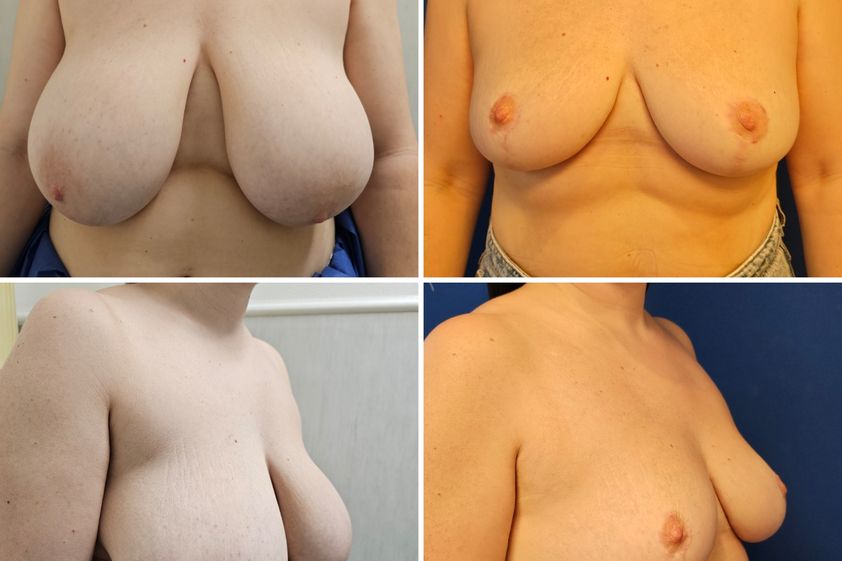 Mastopexia antes y después - 878829