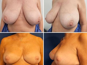Mastopexia antes y después - 878830