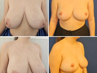 Mastopexia antes y después - 878831