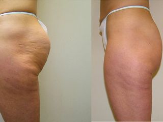Antes y después mesoterapia 