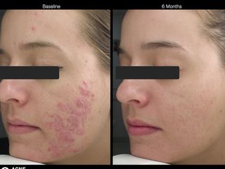 Antes y después Terapia Inducción al Colágeno para cicatrices de acné