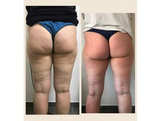 Antes y después mesoterapia 