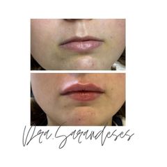 Aumento de labios - Jessica Fabeiro