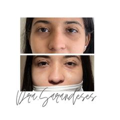 Eliminación de ojeras - Jessica Fabeiro