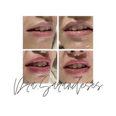 Aumento de labios - Jessica Fabeiro