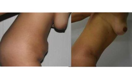 Clínica Granado Tiagonce - Abdominoplastia