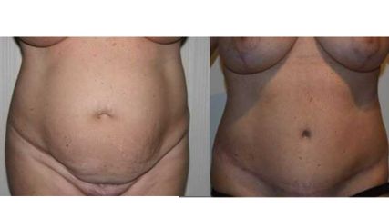 Clínica Granado Tiagonce - Abdominoplastia
