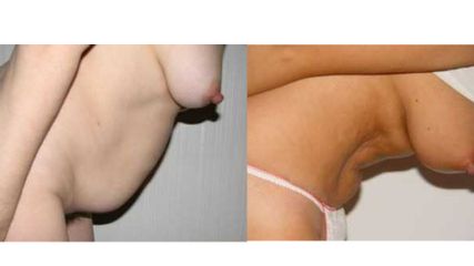 Clínica Granado Tiagonce - Abdominoplastia